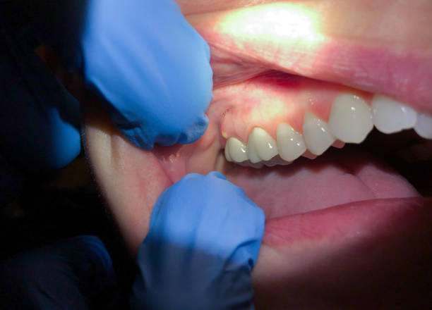 Best Emergency Gum Treatment in Newkirk, OK