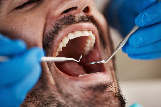 Best Emergency Wisdom Teeth Removal in Newkirk, OK